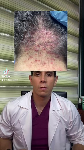 Acné Queloideo de la Nuca: Causas y Tratamientos Efectivos