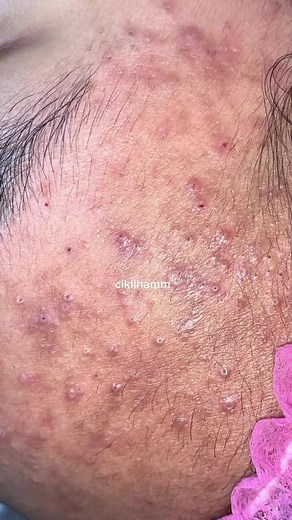 Skin Condition Close-Up: Understanding Forehead Bumps