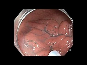Colonoscopy: Submucosal Injection - Tap-tap-tap Technique • Video • MEDtube.net