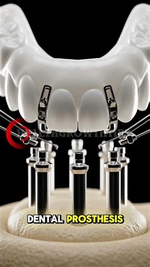 Missing teeth? 🦷 Permanent solutions are here! Smile with confidence again ✨ #DentalImplants