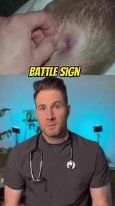 7.2K views · 95 reactions | Battle sign for basilar skull fracture. #skullfracture #headinjury #traumaticbraininjury #erdoctor | Mary Johnson | Facebook