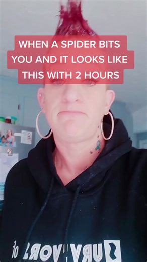 Dealing with a Spider Bite: Red, Swollen, and Full of Pus