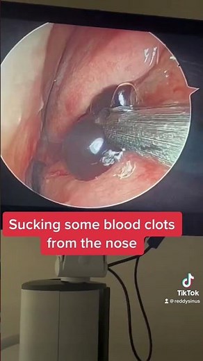 Sucking blood clots from nose after sinus surgery