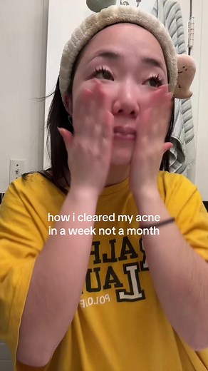 How I Cleared My Acne in Just One Week