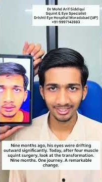 9 Months After Squint Surgery | Amazing Transformation in Large Intermittent Squint | Dr MA Siddiqui