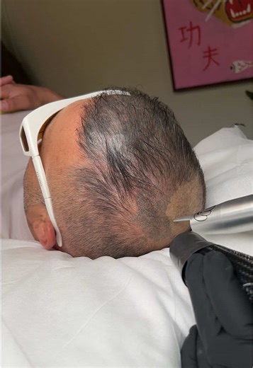 Expert SMP Tattoo Removal Services in Melbourne