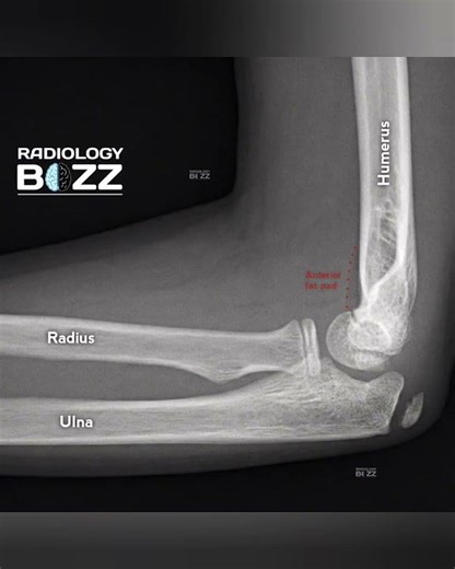 📍 Normal Elbow vs Elbow Effusion – Key Radiographic Differences