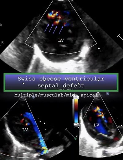 Swiss cheese ventricular septal defect