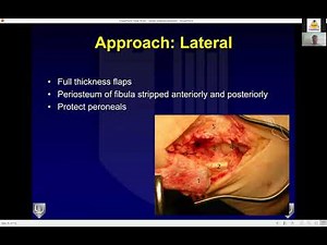 Ankle Replacement in 21st Century