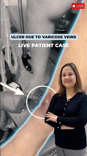 Live Case: Varicose Veins Leading to Leg Ulcer | Dr. Parul Garg Explains the Root Cause