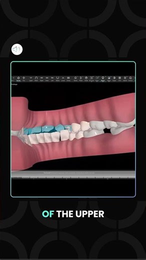 Why Creating an Anterior Open Bite Matters