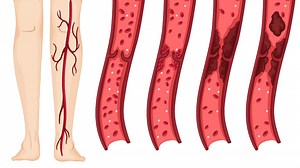 Semnale pe care ni le dă organismul când se instalează tromboza. Lista simptomelor