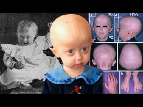 Progeria: The Condition That Ages Kids Before Their Parents
