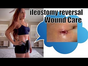Wound Care after Ileostomy Reversal