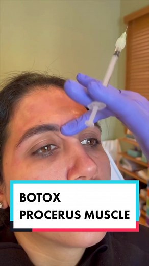 Treating the procerus muscle to alleviate the stronger, horizontal line in this patient's forehead. Here's my unique technique in which I actually rub the toxin into the forehead, which I never really do when injecting neurotoxin anywhere else! #neurotoxin #botox #antiagingtreatment #botoxtechnique #themasterinjector #facialharmonization #malefiller #lipfillers #botoxbeforeandafter #fyp #foryou #foryoupage