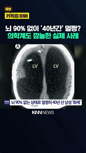 뇌 90%가 물로 채워진 '중증 수두증' "제가 그런 병이라고요?" 멀쩡 남성 / KNN