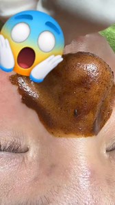 Amazing blackheads remove 🤩🤩😱 . . . . . . . . . #viralreels #fyp #america #video #virals #Amazing #viralvideo #shorts #fyp #foryou #fashion #satisfying #relax #relaxing | SC