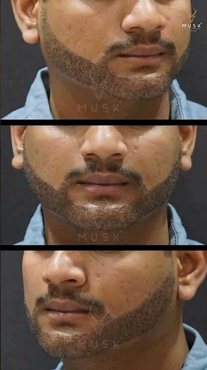 Beard Transplant Before and After | Beard Transplant Results After 6 Months | Musk Clinic, India