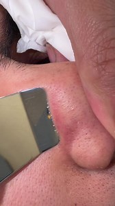 Blackhead removal at home: effective skincare tips