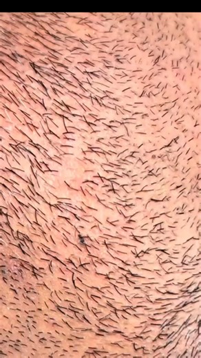 Tired of stubborn mustache hair? 😩 Watch this simple tweezers trick to get smooth, silky skin in seconds! #MustacheRemoval #HowTo #SkincareRoutine #FacialCare #BeautyTips | April-09-04