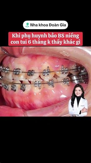 CÓ AI NIỀNG NHƯ VẬY CHƯA ? | Nha Khoa Đoàn Gia