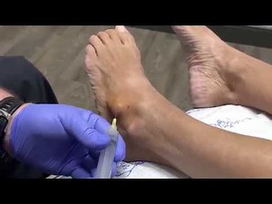 Ganglion Cyst POP with Dr. Hyatt