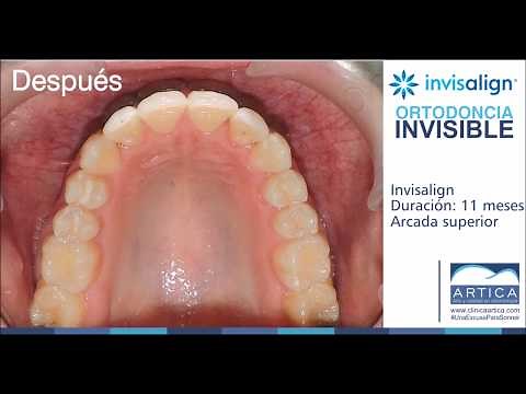 Invisalign ortodoncia invisible - Antes y Después Clínica Ártica