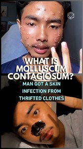 What Is Molluscum Contagiosum? Man Got a Skin Infection From Thrifted Clothes | Cultura Colectiva