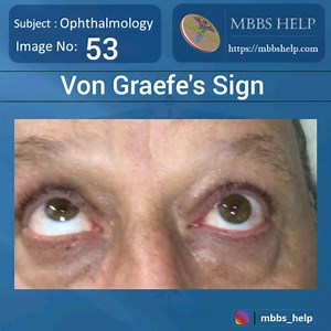 Von Graefe's sign is the lagging of the upper eyelidon downward rotation of the eye, indicating exophthalmic goiter (Graves' Disease) It is a dynamic sign, whereas lid lag is a static sign which may also be present in cicatricial eyelid retraction or congenital ptosis..! #ophthalmology #vongraefesign #gravesdisease #exophthalmicgoiter #lidlag #ptosis #mbbs #help #mbbshelp | MBBS Help
