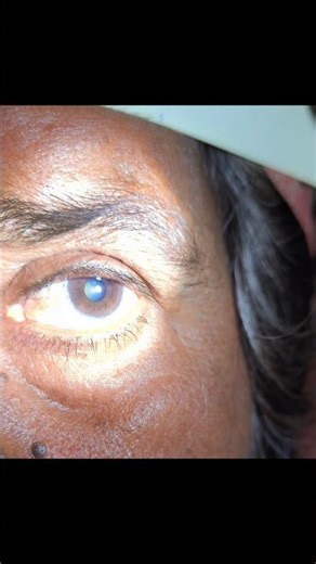 Relative afferent pupillary defect (Marcus Gunn pupil)