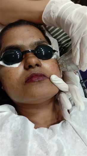 this is how micro needling radio frequency treatment been done for my acne scars.