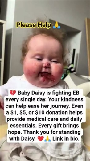 Every second counts. Please help Baby Daisy battle EB. A $20 or $50 donation helps