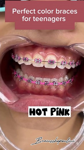 12K views · 59 reactions | Generally, the best braces color for whiter looking teeth are light pinks, and clear shades. However, there is no single rule when it comes to braces color and patients are encouraged to choose the shade that most appeals to them! #braceschristmascolors #perfectcolorforbraces #bracestipsandadvice #bracescare #bracestips #bracesjourney #Braces #bracescolors | Braces Shop Online | Facebook
