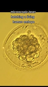 10K views · 33 reactions | Microscopic laser hatching a living human 5-day-old embryo so it can attach to its mother and hopefully become a new life #infertility #IVF #ttc #infertilitywarrior #ivfwarrior #infertilityjourney #Reels #reelsvideo #reelsviral #reelinstagram | Steven Palter | Facebook