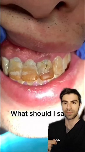Plaque buildup on a bridge #teeth #dentist #dentalhygienist #dentalhygiene #dentista #greenscreenvideo