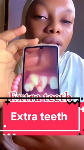 #supernumerary #teeth #toothremoval #xray #makemefamous