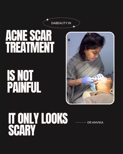 Skin & Hair | Dermatologist on Instagram: "Subsicion is important part of acne scar treatment ! Its looks scary but is actually not ! Hear it from one who got it done"