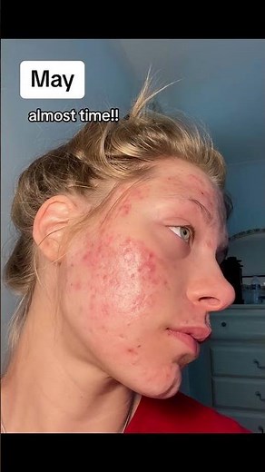 1 Year of Acne & Acne Scar Healing Progress #acnescars #acne #progress