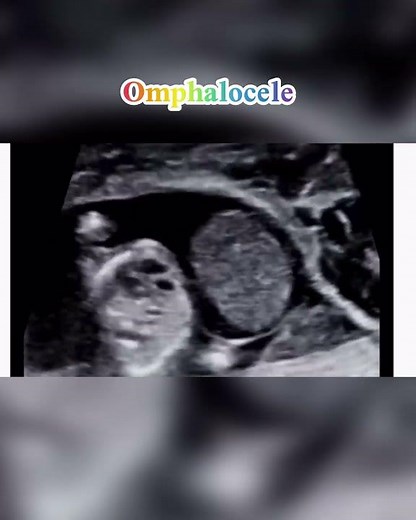 Omphalocele ultrasound #ultrasound #baby #pregnant #pregnancyjourney #education #gastroschisis #doc