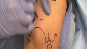 Basics of Elbow Arthroscopy: Positioning, Set-up, Anatomy and Portal Placement