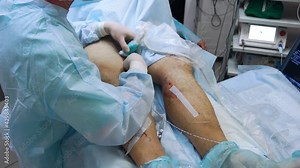 Doctor is performing medical procedure. Endovasal (endovenous) laser coagulation (obliteration) is used to eliminate varicose veins. Insertion of laser with luminous tip directly into vein.