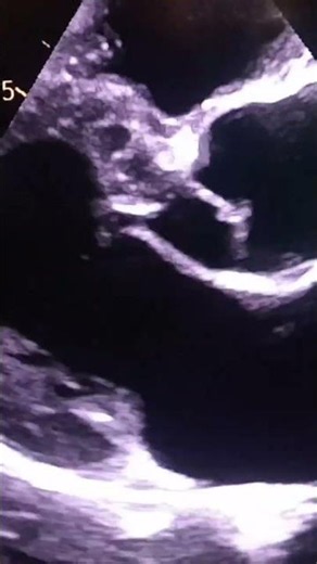 comment on mitral valve #echocardiography