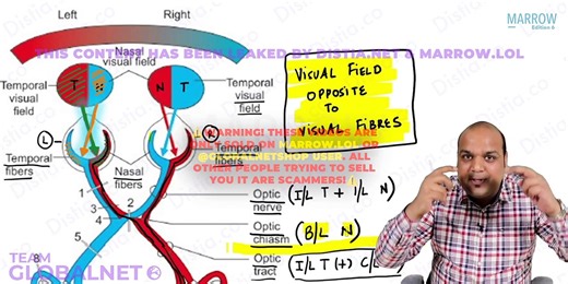 Neuro opthalmology - Visual pathway ,visual field defect yw opthalmology - video Dailymotion