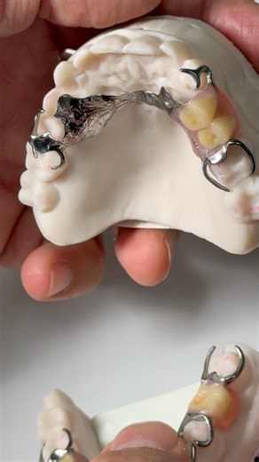 Chrome Cobalt partials for Dr. Todd Sheffler in New Hampshire