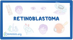 Retinoblastoma: Nursing: Video & Causes | Osmosis