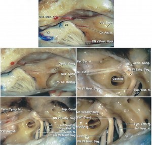 Surgery for Acoustic Neuroma: Middle Fossa Approach | Cohen Collection | Volumes | The Neurosurgical Atlas