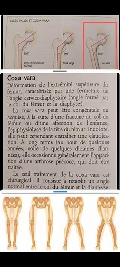 🦴 Coxa Vara