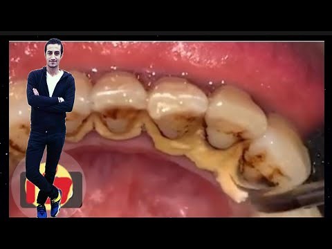 Tartar removal from teeth