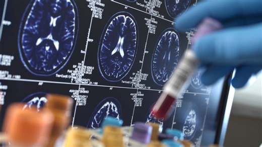 Latest Alzheimer's lab tests focus on memory loss, not brain plaques