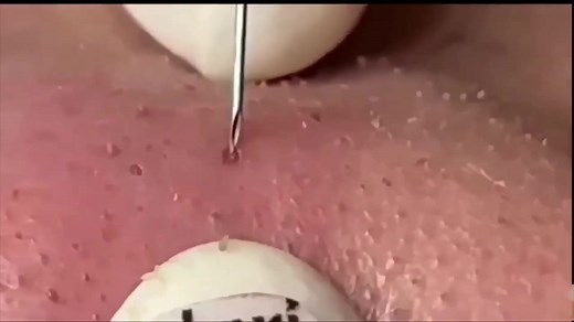 #blackheads #pimples #acne #steatocystema #satisfying #hairs #follicles #nose Hair follicles removal from nose, Extreme blackheads removal from nose, blackheads on nose 3/4